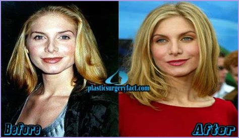 Elizabeth Mitchell Plastic Surgery Before and After